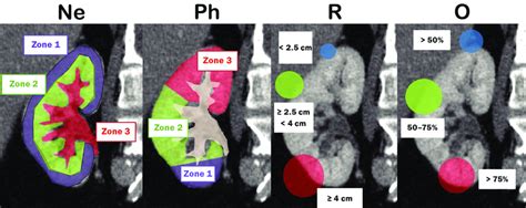 Sagittal CT scan of the kidney showing the renal zones and tumor ...