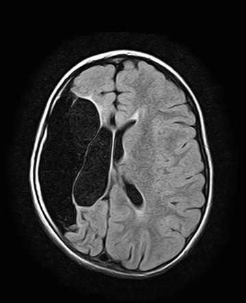 Encephalomalacia | Radiology Case | Radiopaedia.org