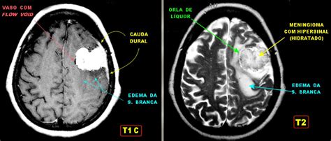 Meningioma