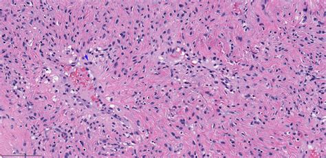 Pathology Outlines Nasopharyngeal Angiofibroma