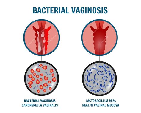 Premium Vector Infographic Of Bacterial Vaginosis In Vector Illustration