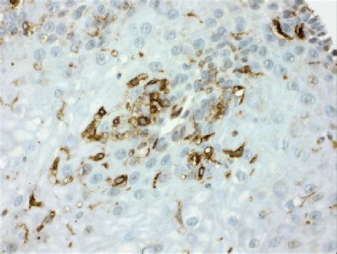 Pathology findings: CD4 lymphocytes evidenced by immunophenotype ...