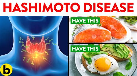 Foods To Eat And Avoid When You Have Hashimotos Disease Youtube