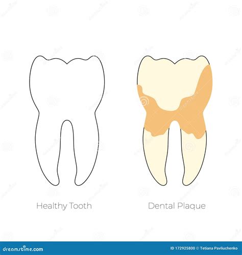 Plaque Or Tartar Cause Of Tooth Periodontal Disease Cartoon Vector