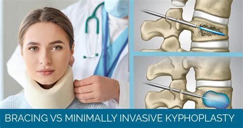 Kyphoplasty Joseph Spine Institute