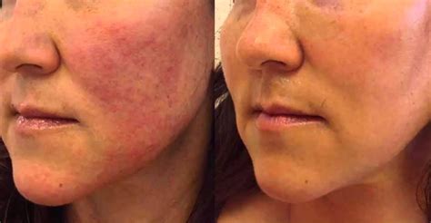 Top 10 Effective Tips For Rosacea Natural Treatment Skin Disease