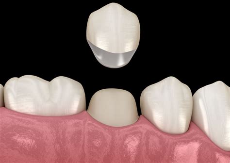 Es necesario poner una corona después de una endodoncia Clínica