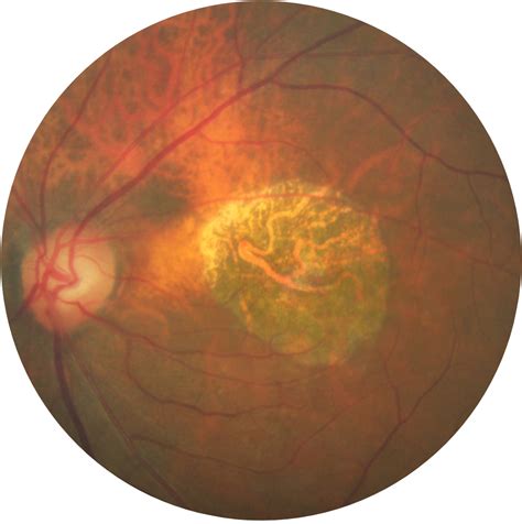 Geographic Atrophy Disease Progression Diagnosis Apellis