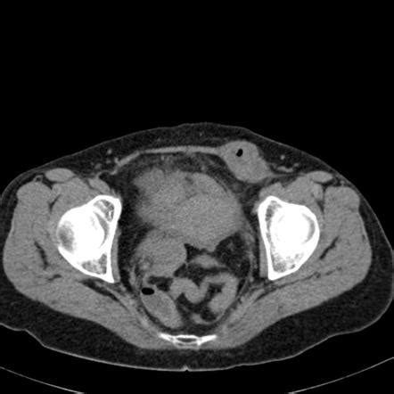 Small Bowel Obstruction Due To An Incarcerated Femoral Hernia