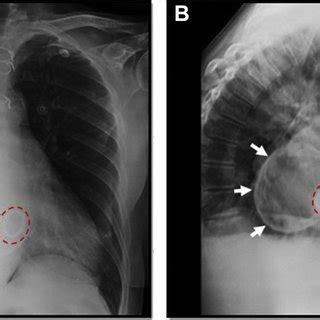 Chest Radiography A Anteroposterior Projection Shows Calcified Rim