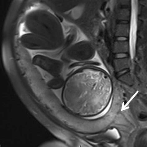 A Sagittal T2 Weighted Image Showing Subserosal Hypervascularity Of