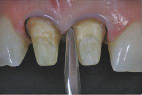 Reconstrução Coronária em Dentes Tratados Endodonticamente Um Passo à