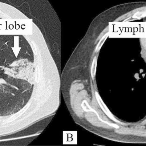 Nsclc Of The Left Upper Lobe A Ct Enlarged Mediastinal Lymph Node Download Scientific