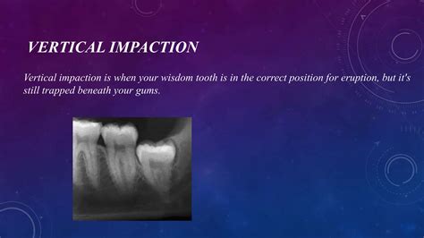 Radiographic Assessment Of Impacted Teeth Pptx