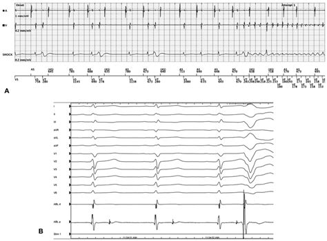 Jcdd Free Full Text Trigger And Substrate Mapping And Ablation For Ventricular Fibrillation