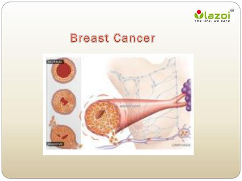 Ppt Breast Cancer Overview Of Symptoms Causes Diagnosis Risk