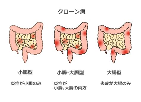 クローン病は完治する？原因や初期症状について医師が解説