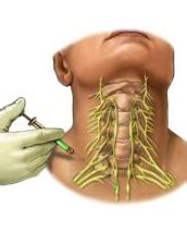 Stellate Ganglion Blocks Midland Spine Institute