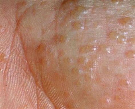 Disidrose Causas Sintomas E Tratamento Dermatologia Est Tica