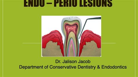 ENDO PERIO LESIONS YouTube