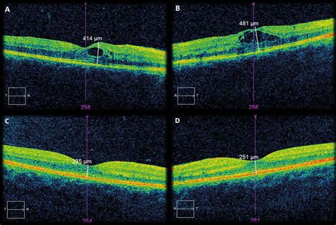 Macular Edema Oct