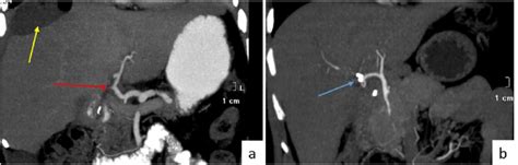 E Angiographic Demonstration Of Vascular Injury A Ligated Right