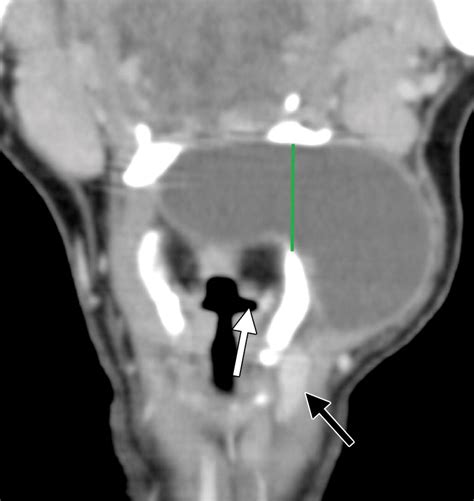 Imaging Of Ectopic Thyroid Tissue And Thyroglossal Duct Cysts