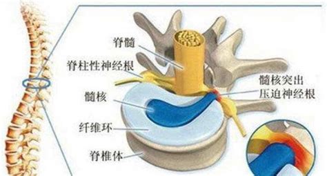 腰椎间盘突出的保守治疗 京东健康