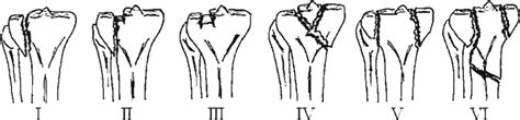 2 Schatzker Classification System Adapted From [13] Download