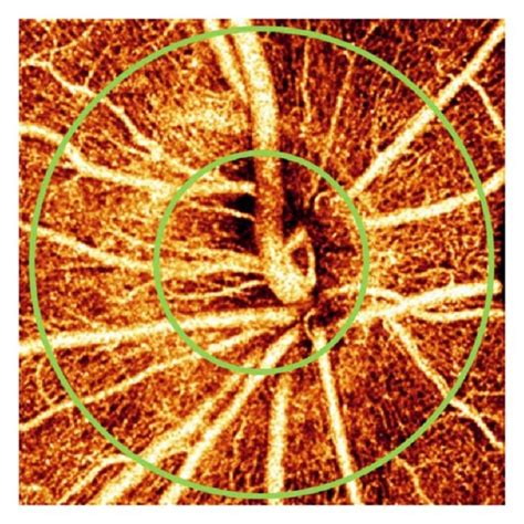 Optic Disc En Face Maximum Decorrelation Projection Angiograms From A