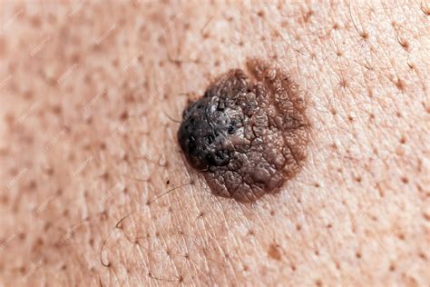 Premium Photo Closeup Of A Dangerous Brown Nevus On Human Skin