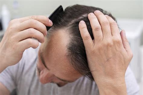 Influenza Del DHT Sull Alopecia MyCapil