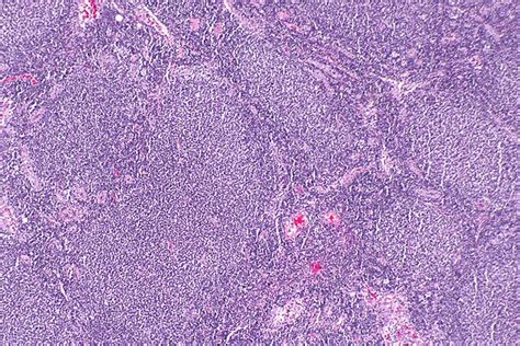 Follicular lymphoma - Libre Pathology