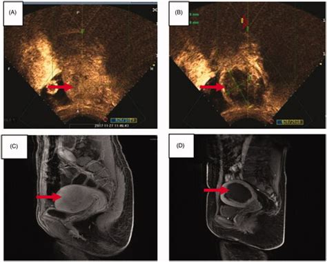 Full Article High Intensity Focused Ultrasound In The Management Of