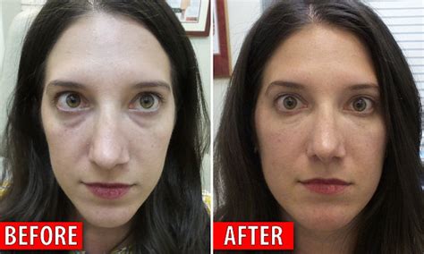 Belotero Before And After Under Eyes