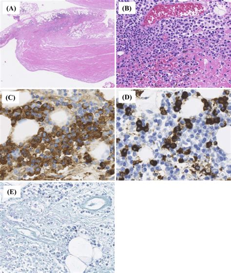 Figure2histopathological Evaluation Of The Pleura And Pleural Effusion