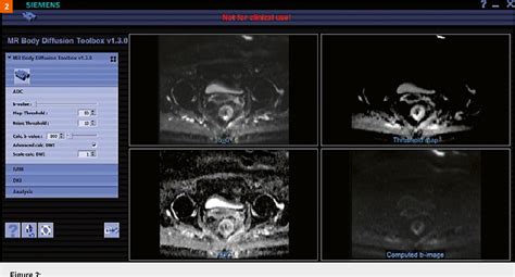 Figure 2 From Diffusion And Perfusion MR Parameters To Assess