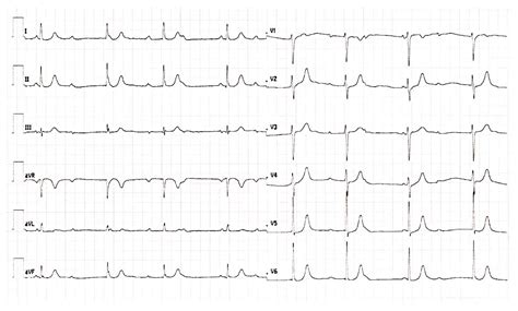 Rbb Block Ecg 11