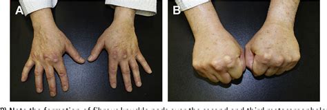 Figure 3 From Hand And Wrist Injuries In Boxing And The Martial Arts