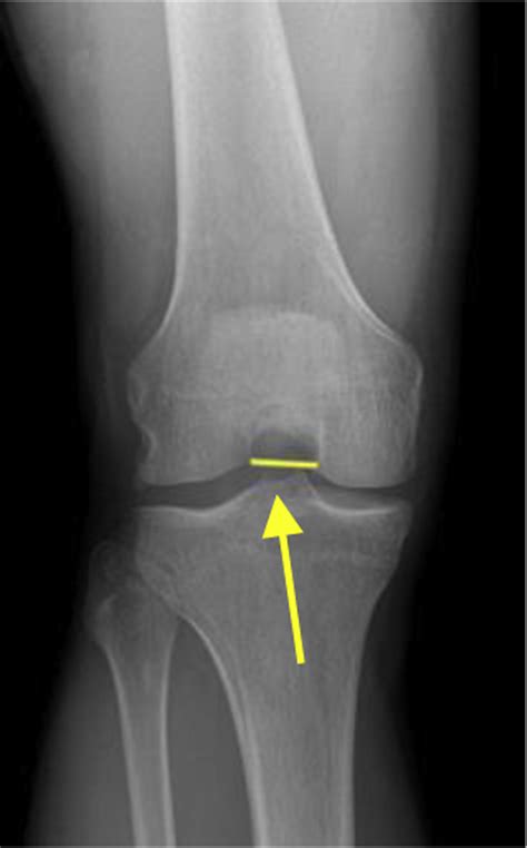 Intercondylar Notch Measurement During Arthroscopy And On Preoperative