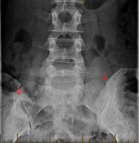 Sacroiliac Joint Dysfunction X Ray