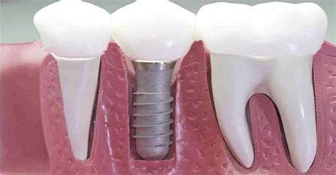 Ventajas Interesantes De Los Implantes Dentales