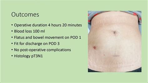 3 Port Laparoscopic D3 Right Hemicolectomy With Transvaginal Natural Orifice Specimen Extraction