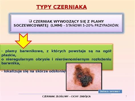 Prezentacja Czerniak Z O Liwy Wiat Prezentacji