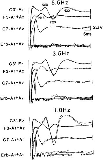 The Effects Of Stimulus Rates On The Amplitude Of Median Nerve