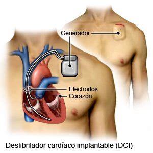 Desfibrilador Cardioversor Implantable Care Guide Information En Espanol