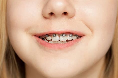 Teen Girl Smile with Braces on Teeth Stock Photo - Image of smile ...