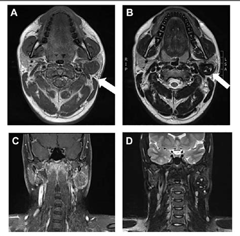 Figure 1 From Küttner Tumor Of The Parotid Gland—a Diagnostic Rarity