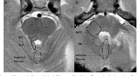 Figure From Diffusion Abnormalities On Intraoperative Magnetic