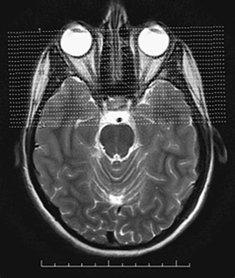 Mri Of The Head And Neck Radiology Key